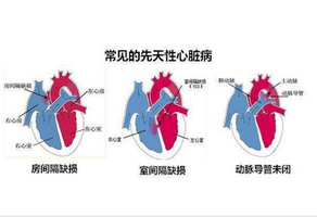 先天性心脏病的症状有哪些？